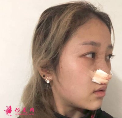 昆明美伊萊醫(yī)療美容鼻部多項案例