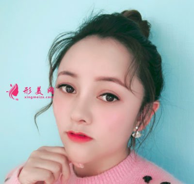 昆明韓辰醫(yī)療美容醫(yī)院鼻部多項案例