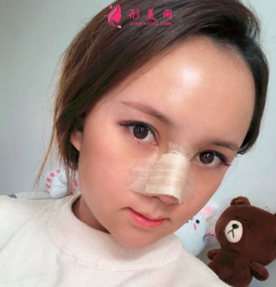 昆明韓辰醫(yī)療美容醫(yī)院鼻部多項案例