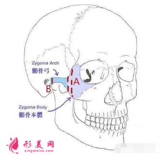 顴骨寬大：做一個(gè)顴弓內(nèi)推術(shù)治標(biāo)又治本！