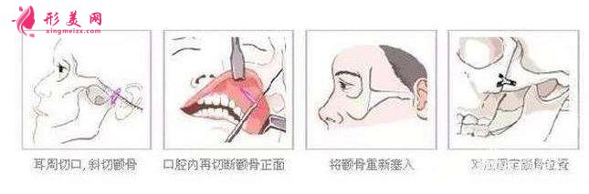 顴骨寬大：做一個(gè)顴弓內(nèi)推術(shù)治標(biāo)又治本