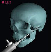 磨骨顴骨手術是怎樣操作的？手術步驟流程