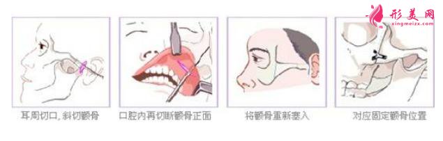 顴弓骨整形手術(shù)的優(yōu)勢