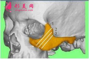 顴弓骨整形手術(shù)前的注意事項