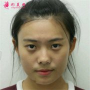 杭州同榮麗格醫(yī)療美容全切雙眼皮術后恢復效果反饋