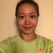 杭州藝星醫(yī)療美容醫(yī)院小仙女的面部線雕術后效果分享