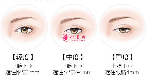 眉眼小拉皮有什么優(yōu)勢(shì)