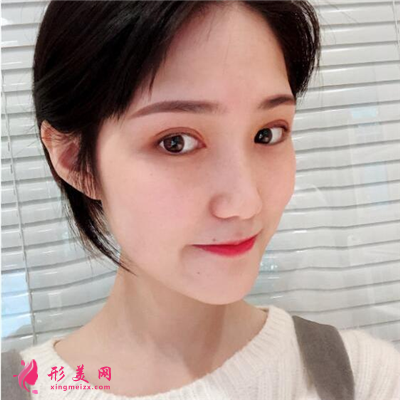 鄭州切開雙眼皮術(shù)后案例反饋，小姐姐長得好可愛啊~