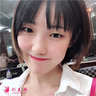 鄭州切開雙眼皮術(shù)后案例反饋，小姐姐長得好可愛啊~