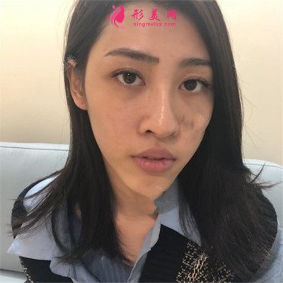 成都自體肋軟骨隆鼻術(shù)后恢復(fù)情況對比圖分享