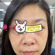 深圳鵬愛整形醫(yī)院激光去黃褐斑案例，皮膚無暇透亮