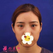 廣州廣大整形醫(yī)院雙眼皮修復(fù)案例，眼睛自然多了