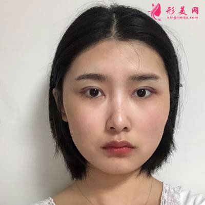 廣州星團整形醫(yī)院的全切雙眼皮案例