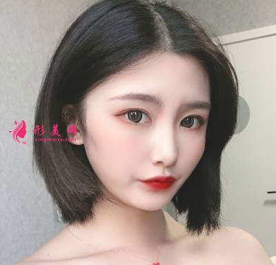 廣州星團整形醫(yī)院的全切雙眼皮案例