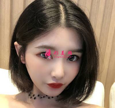 廣州星團整形醫(yī)院的全切雙眼皮案例