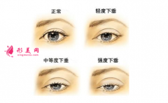 割雙眼皮整形醫(yī)院-割雙眼皮效果怎么樣？