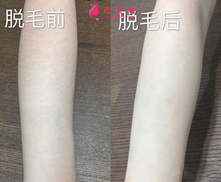 石家莊美聯(lián)臣激光脫毛會不會灼傷皮膚?