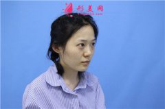 濟(jì)南海峽美容整形醫(yī)院鼻綜合術(shù)后恢復(fù)情況對比圖分享