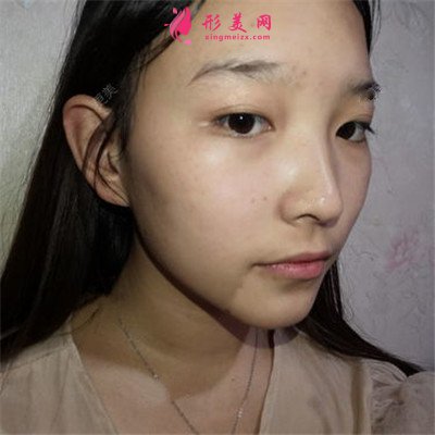 廈門全切雙眼皮術(shù)后案例效果分享