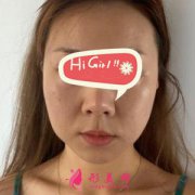 成都晶膚整形醫(yī)院熱瑪吉除皺案例，肌膚逆齡生長(zhǎng)