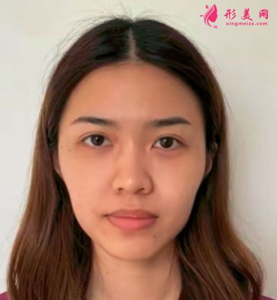 廈門安黛美醫(yī)療整形美容自體脂肪面填案例