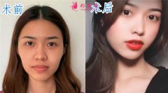 在北京新星靚醫(yī)療美容做自體脂肪面填，術(shù)后47天真人效果案例分享