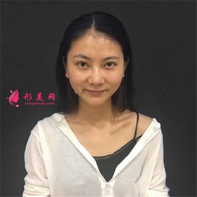 深圳耳軟骨隆鼻術(shù)后恢復情況對比