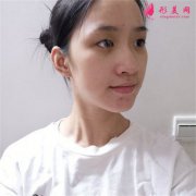 北京彤美醫(yī)療美容醫(yī)院小仙女全切雙眼皮術(shù)后恢復(fù)效果分享