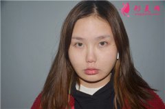 長(zhǎng)沙梵童醫(yī)療吸脂瘦臉術(shù)后恢復(fù)效果展示