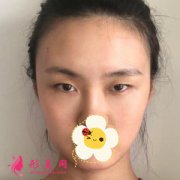 蘭州時(shí)光整形醫(yī)院眼綜合案例 眼睛的弧度很美