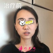 濟(jì)南愛容整形醫(yī)院熱瑪吉除皺心得分享 值得一試