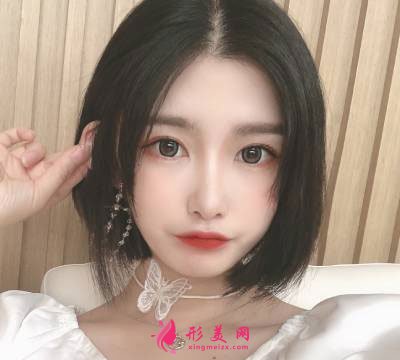 廣州星團(tuán)整形醫(yī)院的全切雙眼皮案例