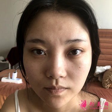 無錫小姐姐鼻綜合術(shù)后恢復(fù)情況分享