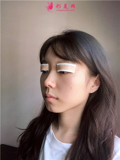 杭州小仙女切開雙眼皮術后恢復情況反饋