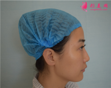 杭州同榮麗格醫(yī)療美容面部埋線提升術(shù)后恢復(fù)情況分享