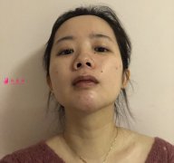 深圳富華曹夢(mèng)君醫(yī)師真人案例 隆鼻110天前后對(duì)比圖