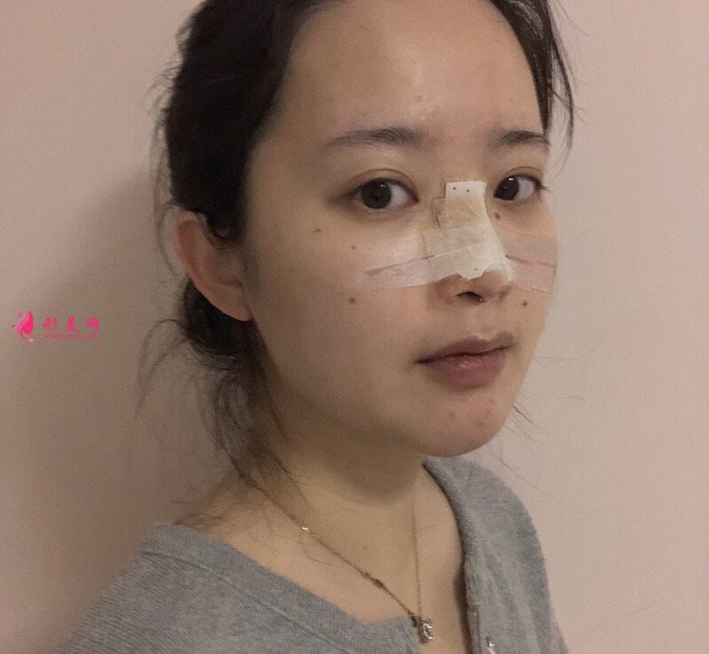 深圳富華曹夢君醫(yī)師真人案例 隆鼻110天前后對比圖分享