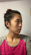 鄭州附二院面部埋線提升術(shù)后效果分享
