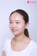 成都恒博植發(fā)小姐姐種植發(fā)際線手術(shù)術(shù)后效果分享
