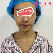 在西安西京做熱瑪吉除皺后年輕五歲不是夢，很推薦