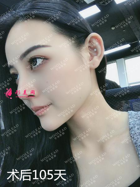 找鄭州華領(lǐng)朱志娟院長(zhǎng)做鼻綜合術(shù)后105天