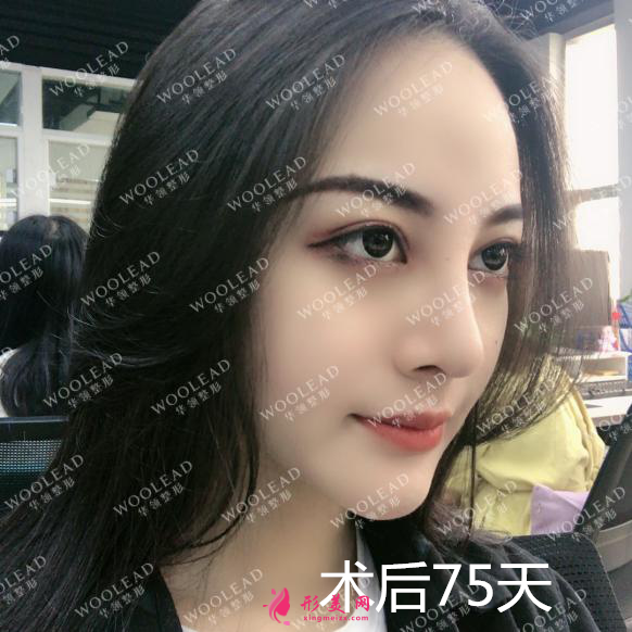 找鄭州華領(lǐng)朱志娟院長(zhǎng)做鼻綜合術(shù)后75天