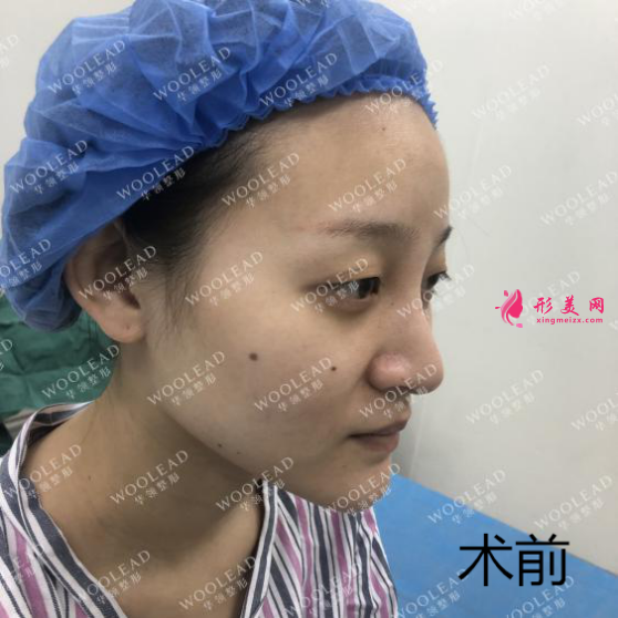 找鄭州華領(lǐng)朱志娟院長做鼻綜合手術(shù)前