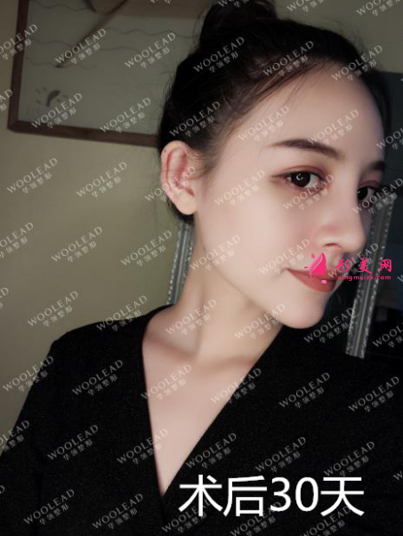 找鄭州華領(lǐng)朱志娟院長做鼻綜合術(shù)后30天