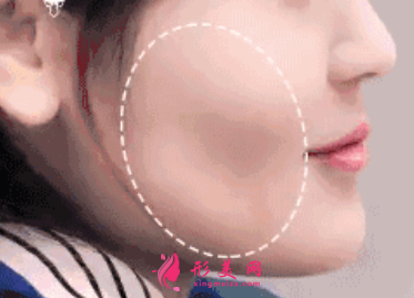 自體脂肪填充臉頰效果可以保持多久
