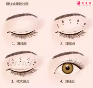 腫泡眼可以做埋線雙眼皮手術(shù)嗎？