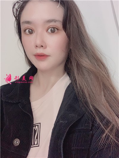 南寧全切雙眼皮術(shù)后恢復(fù)情況對比 術(shù)后 南寧全切雙眼皮術(shù)后恢復(fù)情況對比