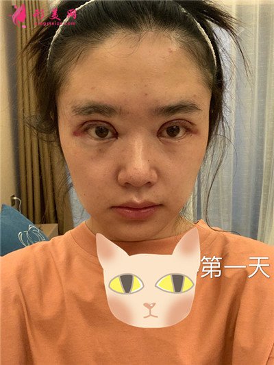 南寧全切雙眼皮術(shù)后恢復(fù)情況對比