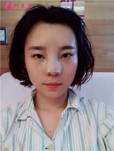 鄭州鼻部綜合術(shù)后案例反饋