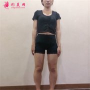重慶軍美醫(yī)療整形水動力吸脂瘦大腿恢復(fù)情況分享